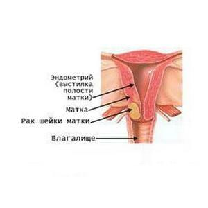 Як розпізнати перші симптоми та ознаки раку матки на ранній стадії?